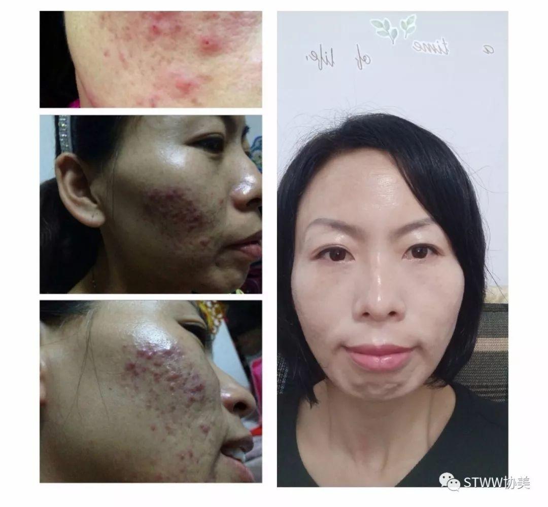 【每日一星】中医养生工作者的祛痘抗衰故事--朱莉