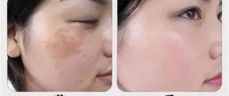 脸上长斑如何解决，NU SKIN还肌肤一份“清白”！